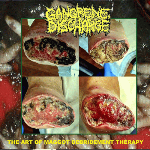 Gangrene Discharge : The Art of Maggot Debridement Therapy